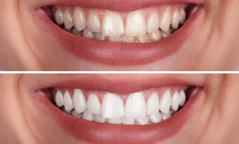 Teeth-whitening