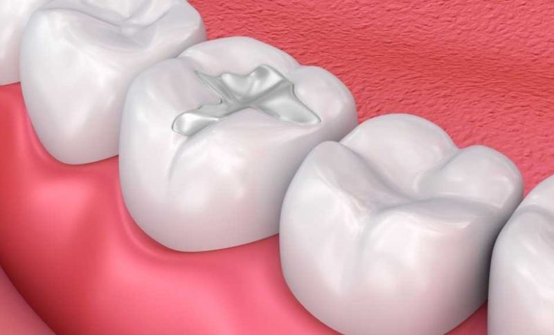 White-fillings-