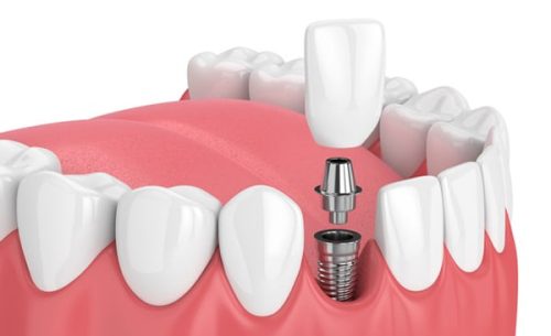 Dental-implants-